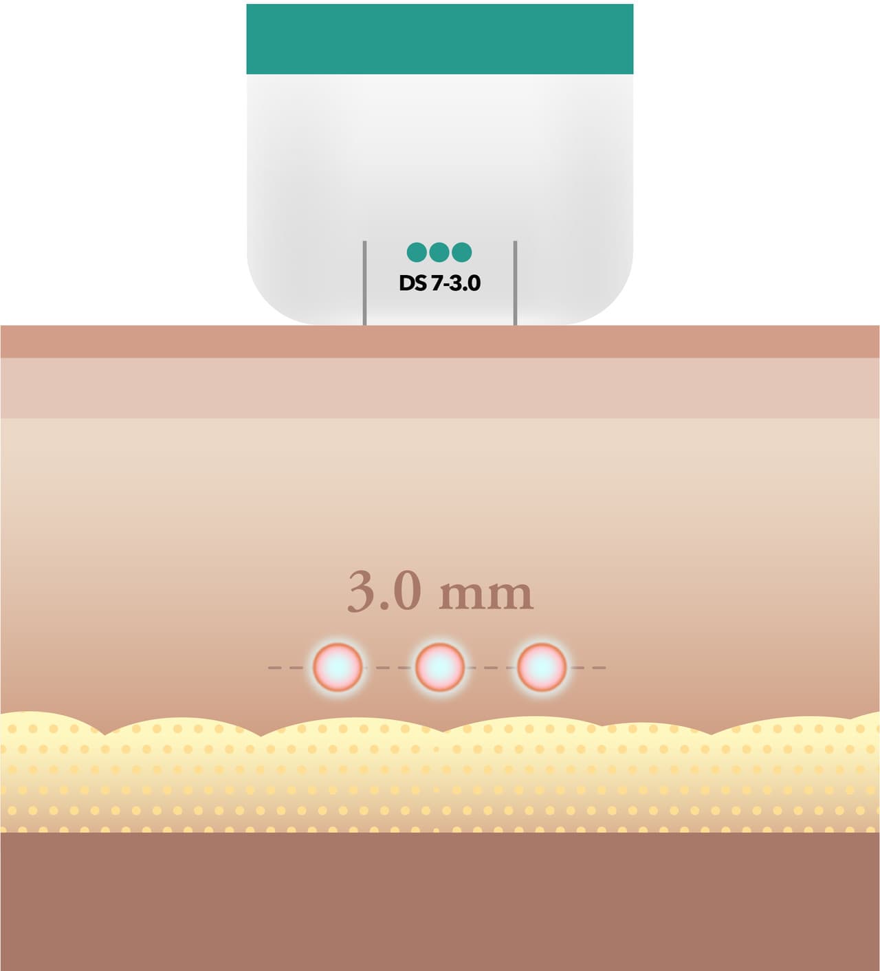 Ulthera tips and energy settings adjusted per patient at DA Dermatology Dosan
