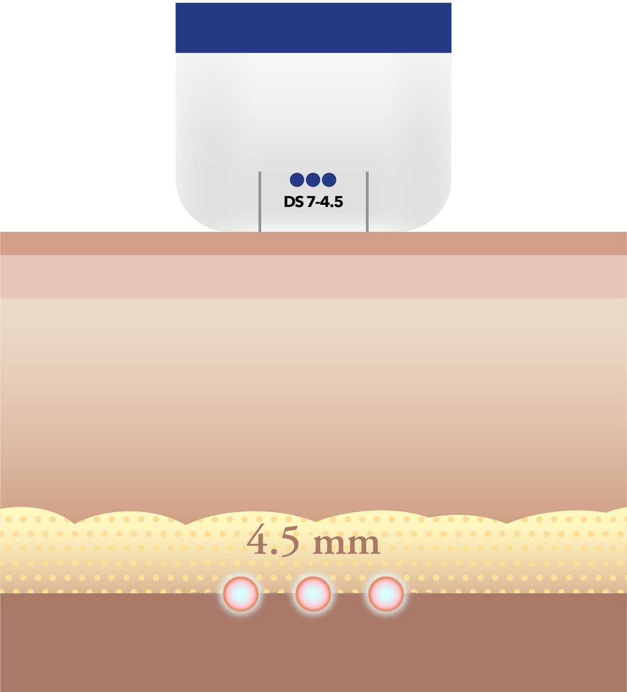 Ulthera tips and energy settings adjusted per patient at DA Dermatology Dosan